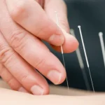 Terapi Akupuntur Medik dari Efje Klinik