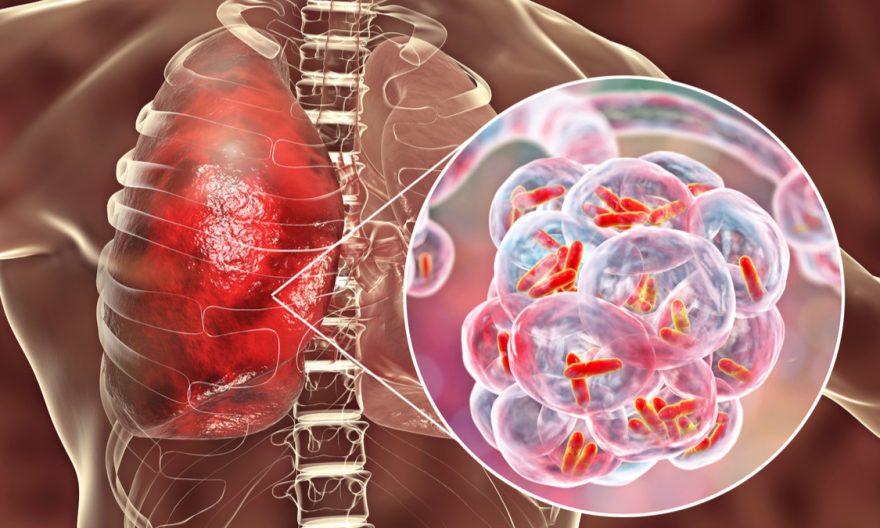 penyakit Pneumonia